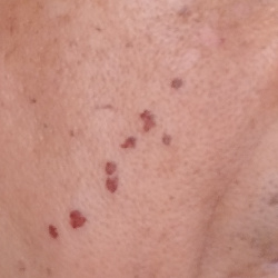 Mango Pulp Weevil: A Pest Control Problem in Palawan Island 5 burnt skin due mango sap
