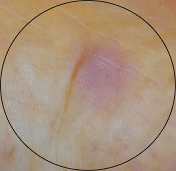 Running at an Even Pace Works Better than Negative or Positive Splits 1 inflamed skin